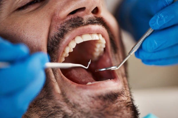 Best Emergency Wisdom Teeth Removal in Elk River, MN